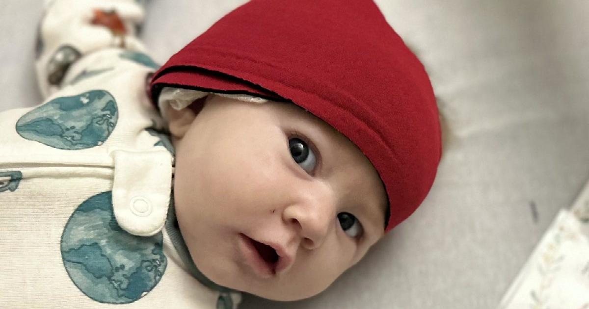 “A beautiful moment”: Newborn battling meningitis becomes among youngest to ever receive cochlear implant