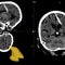 Woman found living with needle in her brain after failed WWII infanticide