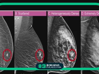 Understanding Breast Density  Western Missouri Medical Center