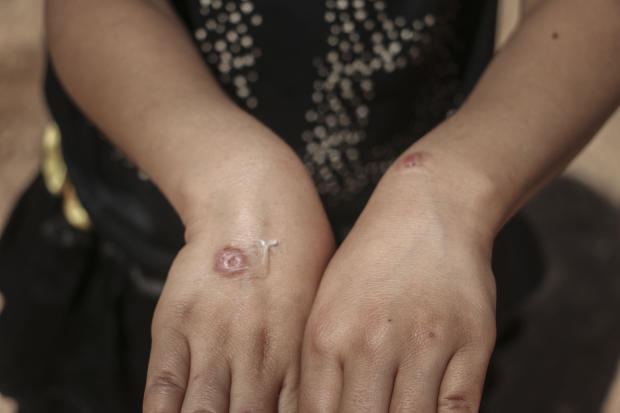 Leishmaniasis disease spreads in refugee camps in Syria 