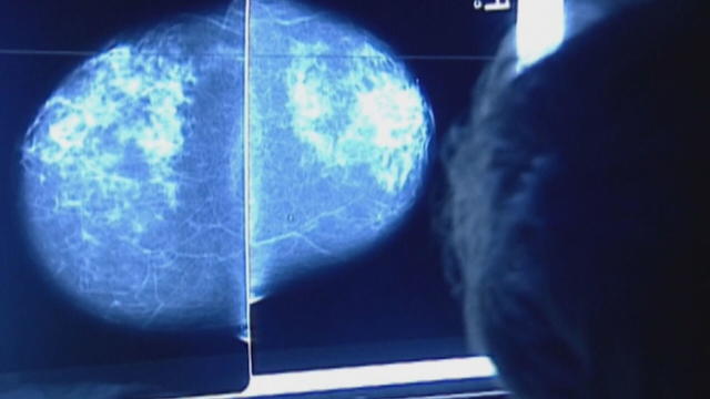 inflammatory-breast-cancer.jpg 