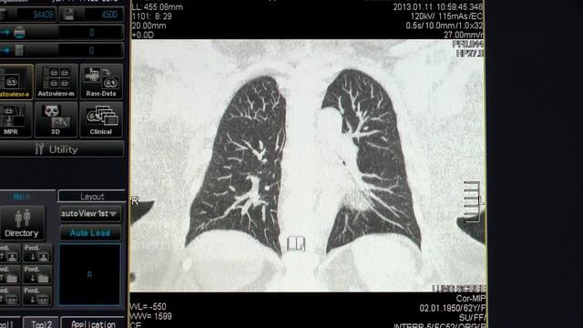 9am-vo-lung-cancer-wcbs8e9c-hi-res-still-1.jpg 