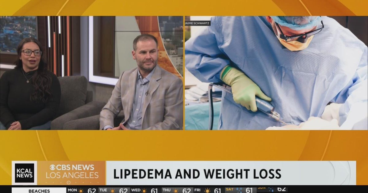 How lipedema can prevent weight loss CBS Los Angeles