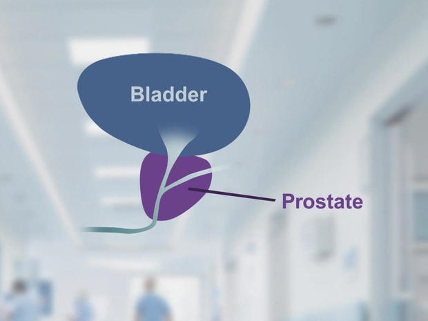 bladder-prostate-1280.jpg 