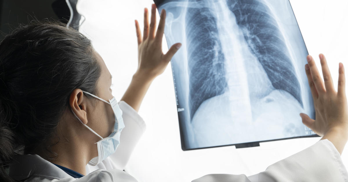 Ранното откриване може да помогне на Кентъки да овладее кризата с рака на белите дробове