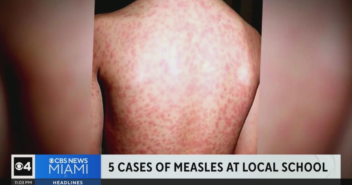 5th case of measles detected in Broward, Florida Department of Health ...