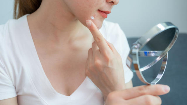 Cropped shot of woman trying to applying acne cream on her skin for solving acne problem. 