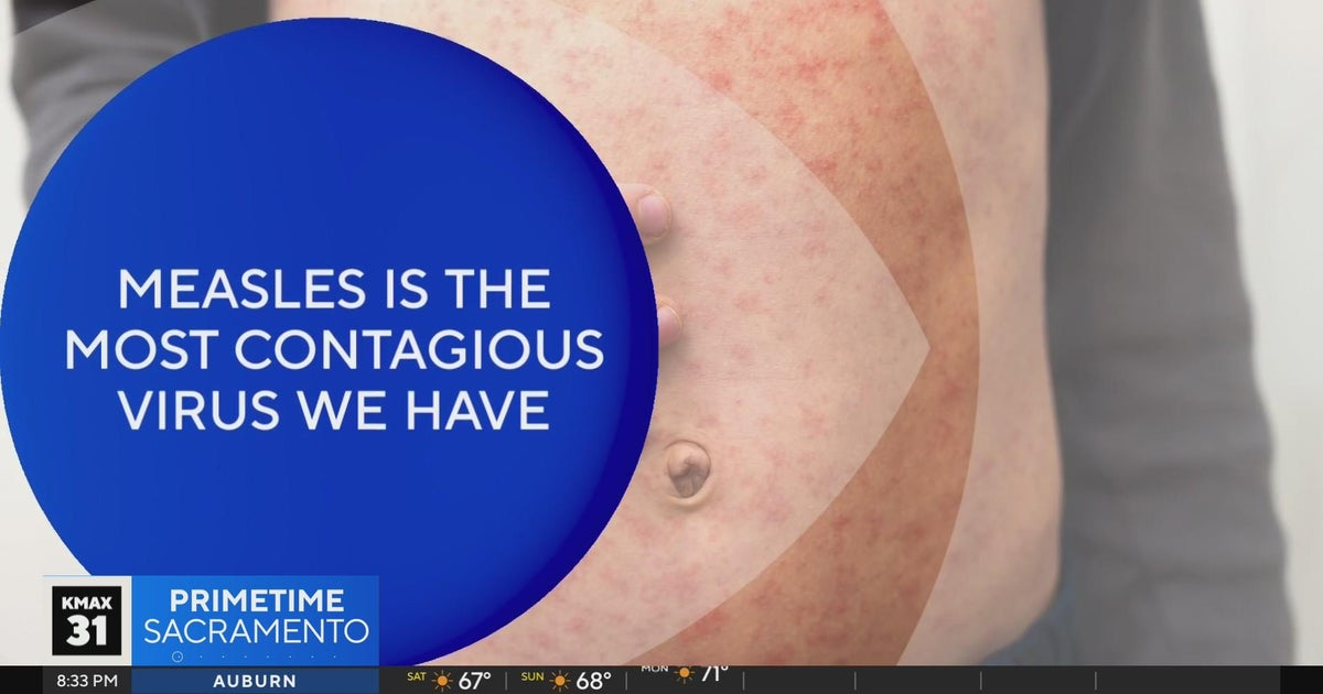The Answer: What to know with recent measles outbreaks?