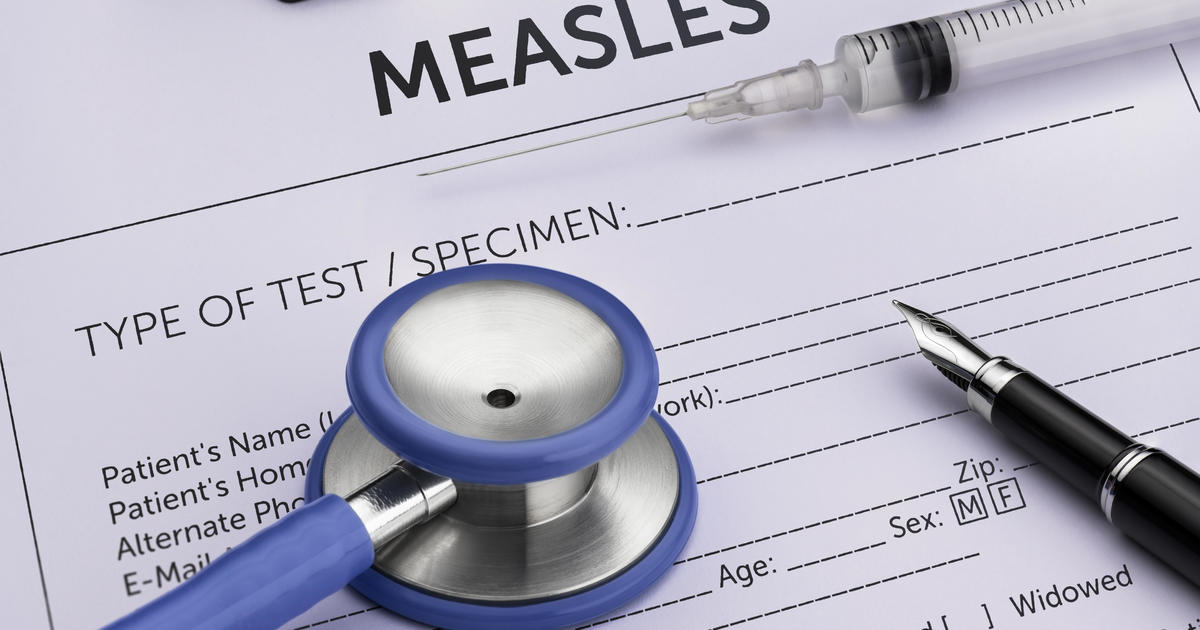 Merced County health officials confirm potential exposure to measles