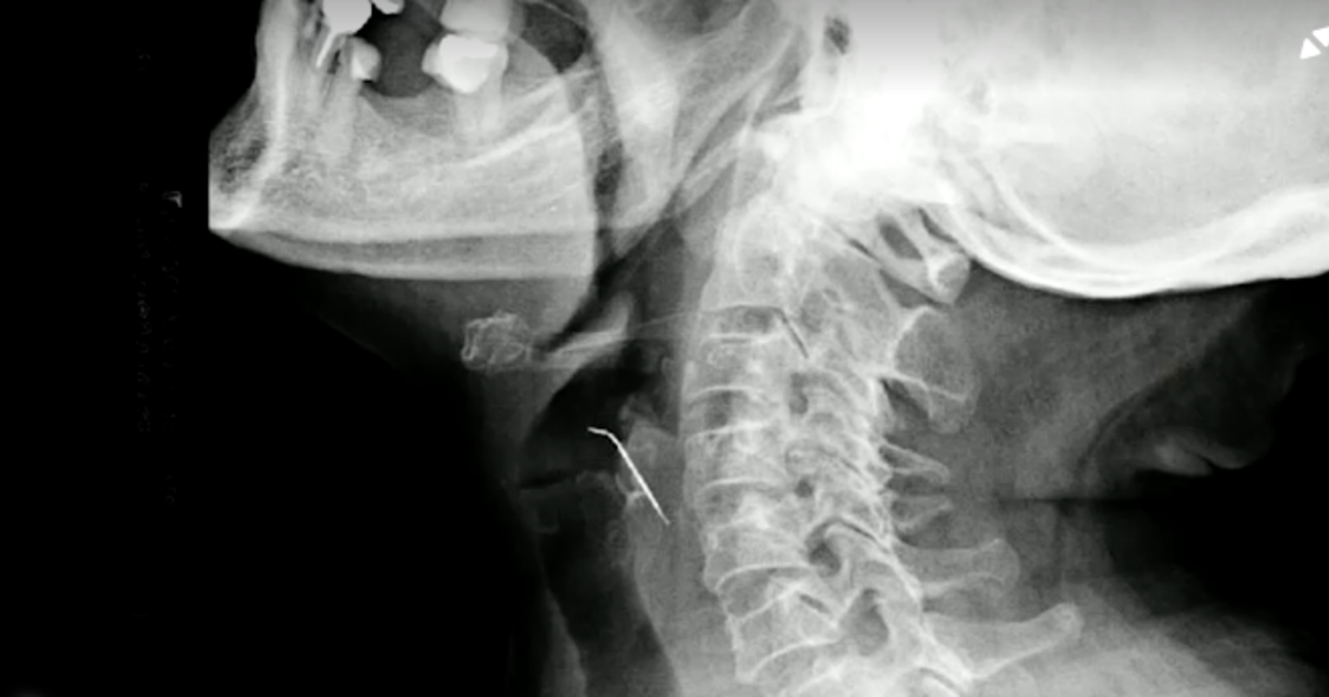 Жена отиде в спешното отделение, мислейки, че има заседнала кост в гърлото. Това беше пирон, пронизващ артерията й.