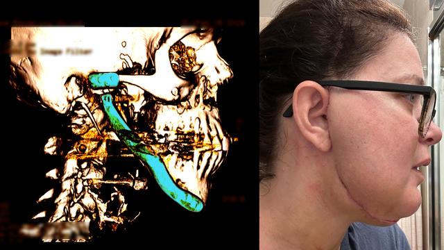 Photos of Lisa Schmidt and a medical scan of her jaw showing hardware implants 