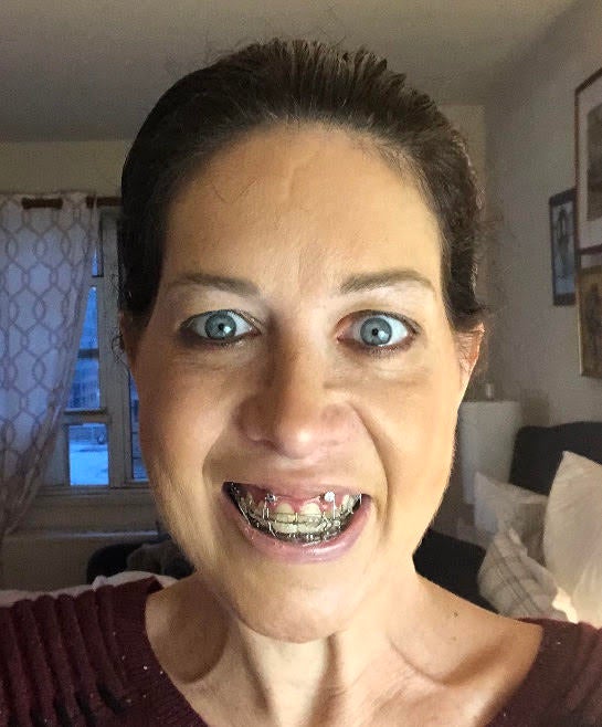 Jenny Feldman, with her jaws wired shut after surgery