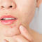 Stress can be "triggering factor" for skin problems. Here's expert advice.