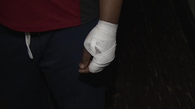 A man's left hand wrapped in bandages 