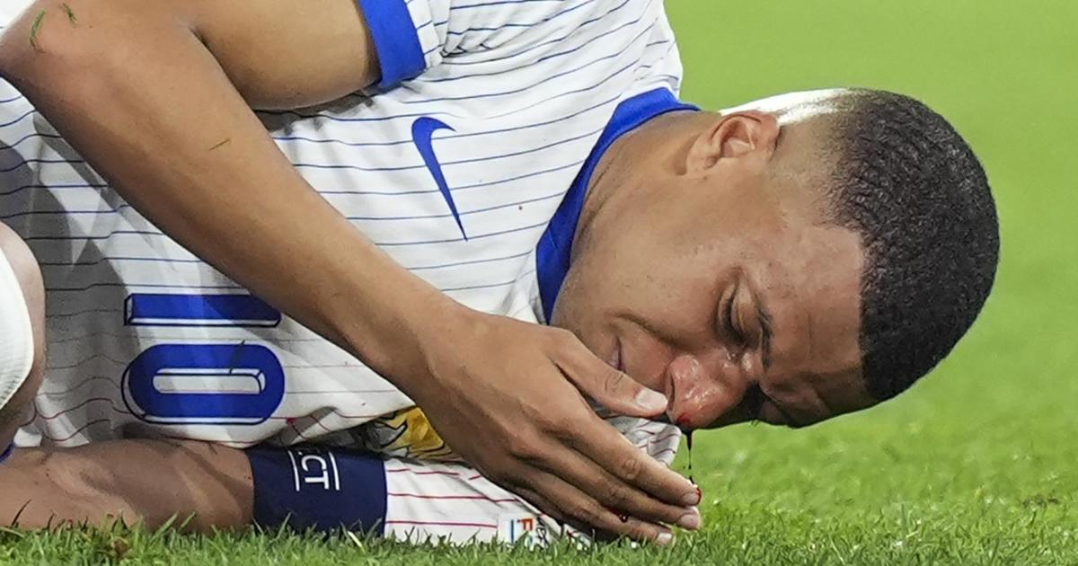 France's Kylian Mbappé sufferers broken nose in Euro 2024 match