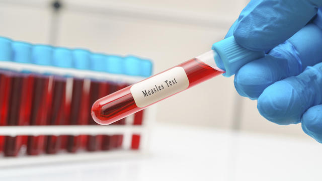 Measles blood test, conceptual image 