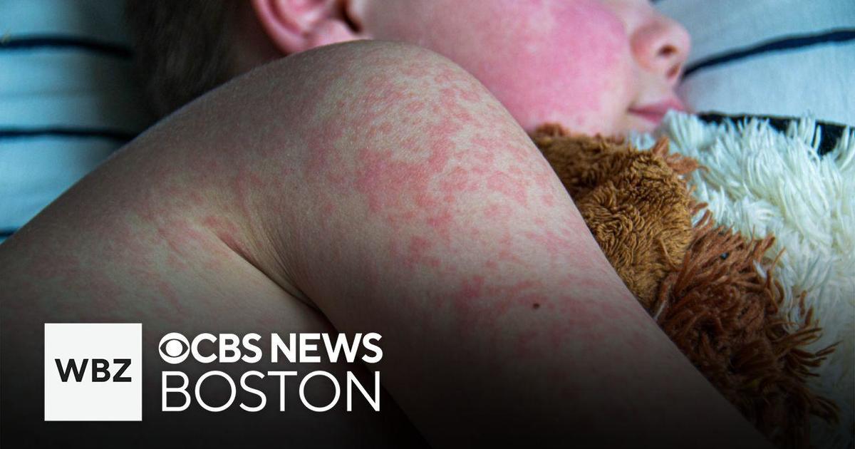 Possible contact with measles in New Hampshire and Massachusetts, residents urged to watch for symptoms