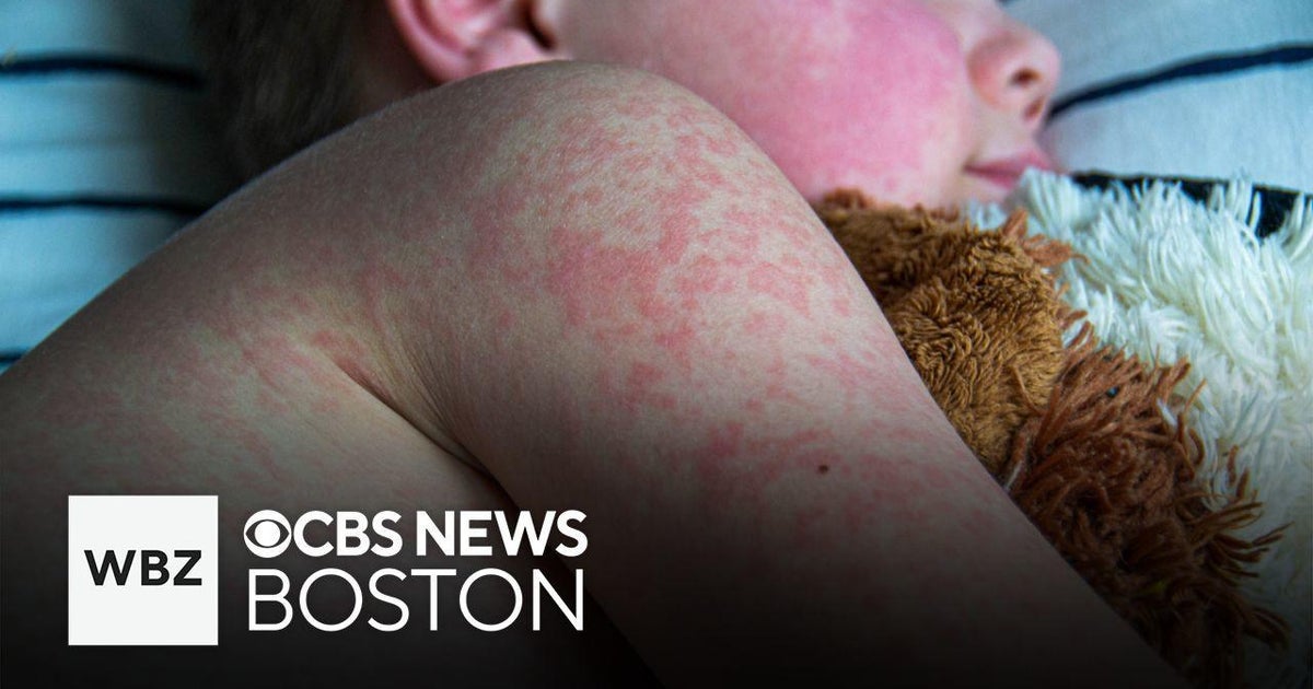Possible measles exposure in New Hampshire and Massachusetts, residents urged to check for symptoms Possible measles exposure in New Hampshire and Massachusetts, residents urged to check for symptoms