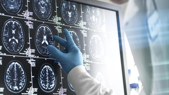 Doctor analyzing patients brain scan on screen 