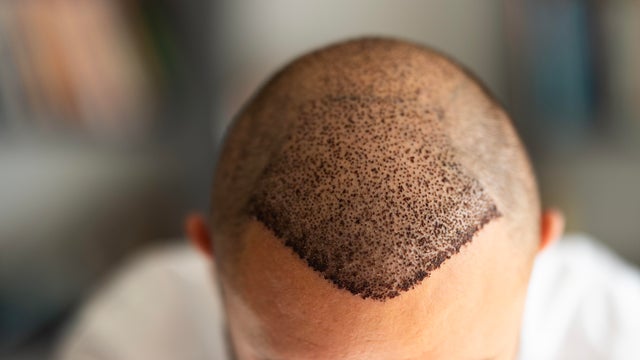 Top view of scalp after hair transplant surgery 