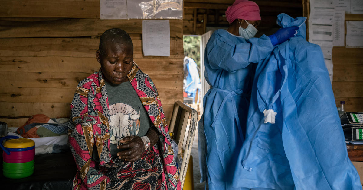 Congo receives first desperately needed MPOX vaccines, but vaccination campaign faces enormous challenges