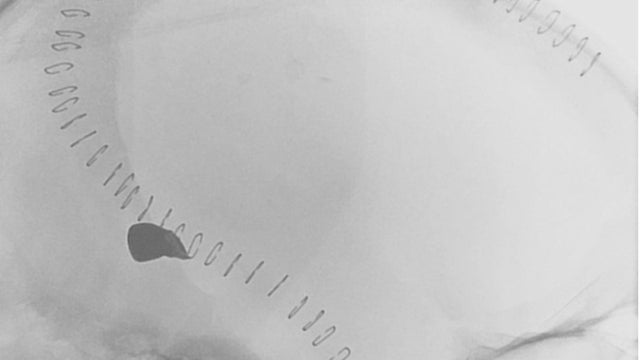 Chris Smith brain X-ray