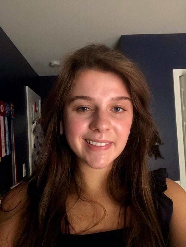 2-july-2021-a-couple-months-into-the-paralysis-starting-and-a-month-after-having-my-first-nerve-graft-surgery-this-was-the-only-photo-i-have-smiling-with-teeth.jpg