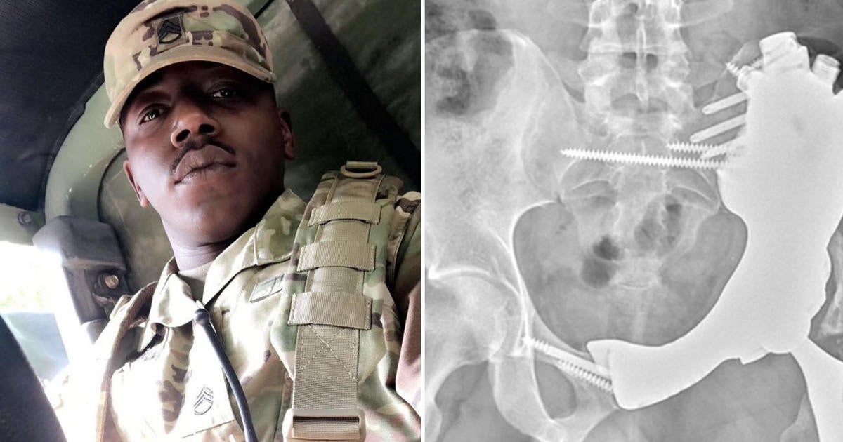 An Army veteran thought he knew the cause of his knee pain. Doctors found a rare cancer