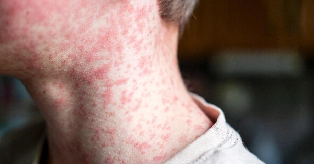 First measles death reported in Texas child amid outbreak infecting more than 120 people