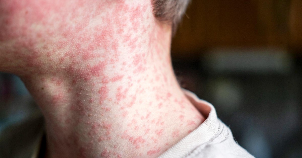 First measles death reported in Texas child as outbreak spreads First measles death reported in Texas child as outbreak spreads