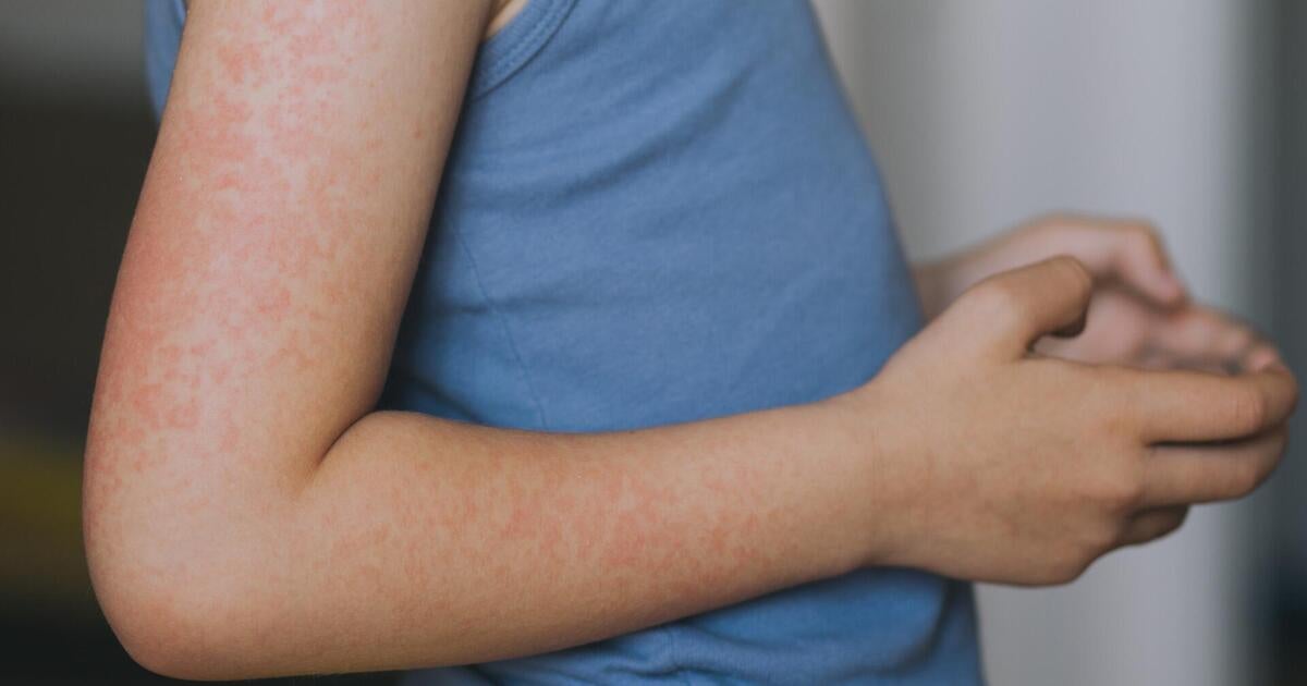 Measles alert in New Jersey, cases reported in several states