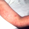 Weekly measles cases hit new record amid worst outbreak since 1990s