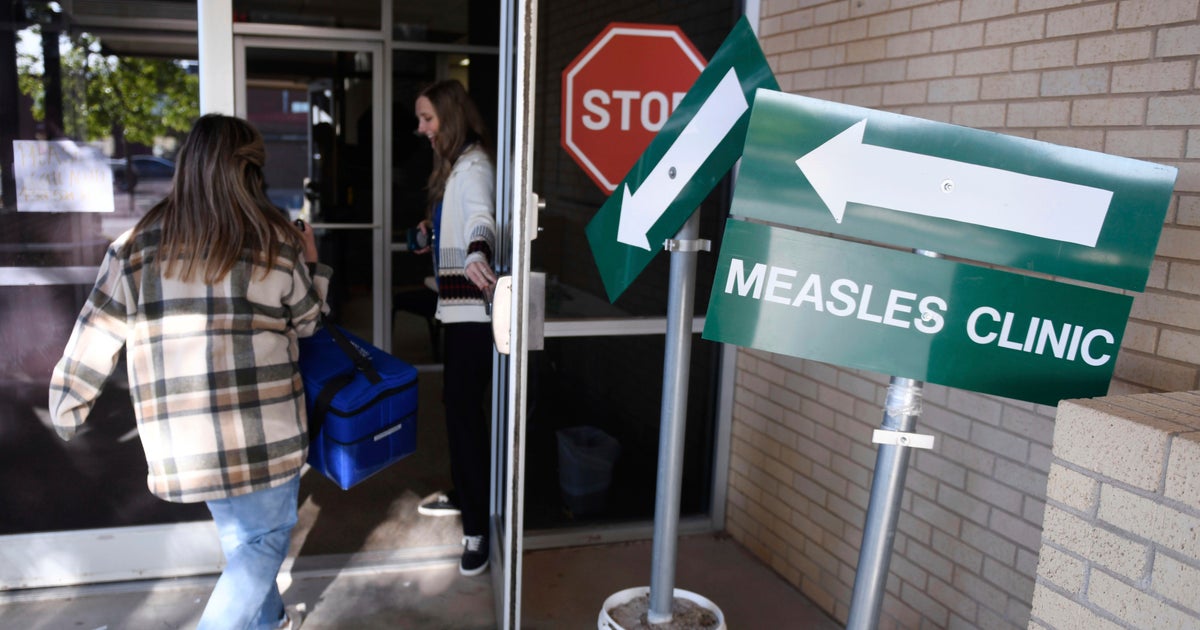 Large number of measles cases being missed, CDC says Large number of measles cases being missed, CDC says