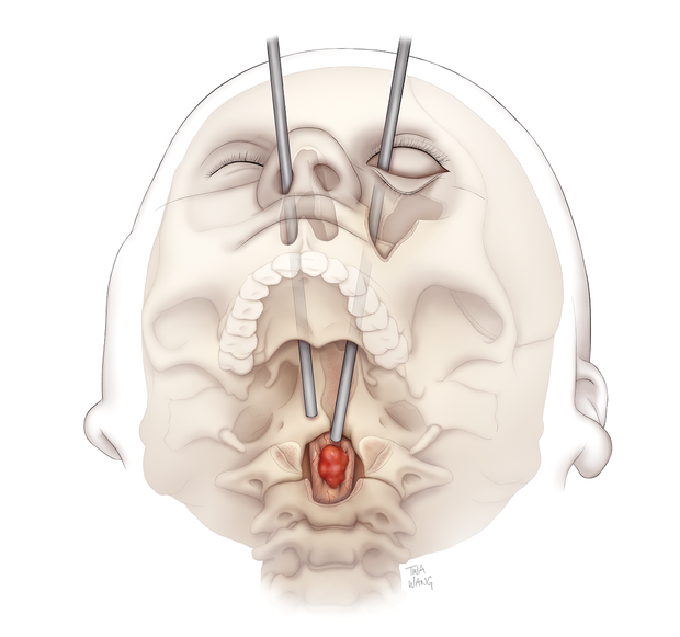Illustration of Exemplary Muscle-Spine-Myeloma 