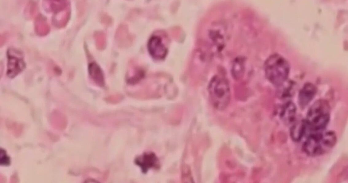 Oakland County health officials confirm measles exposure site in Rochester Hills