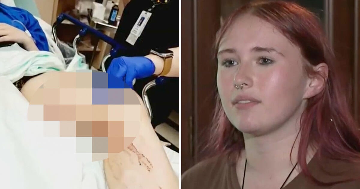 Florida teen fights off alligator that latched onto her leg 