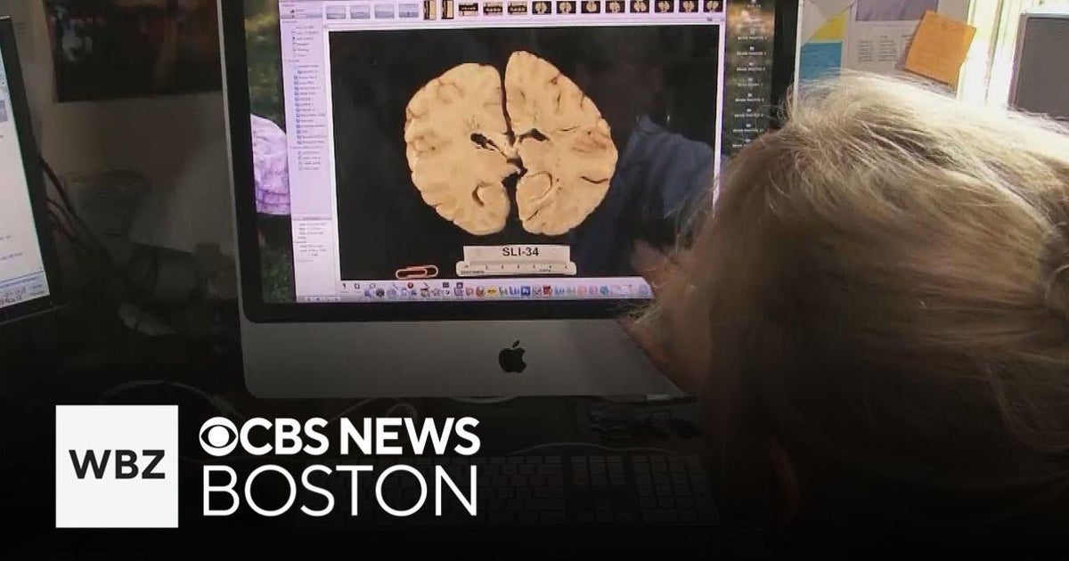 BU research has found high school sports can lead to development of CTE BU research has found high school sports can lead to development of CTE