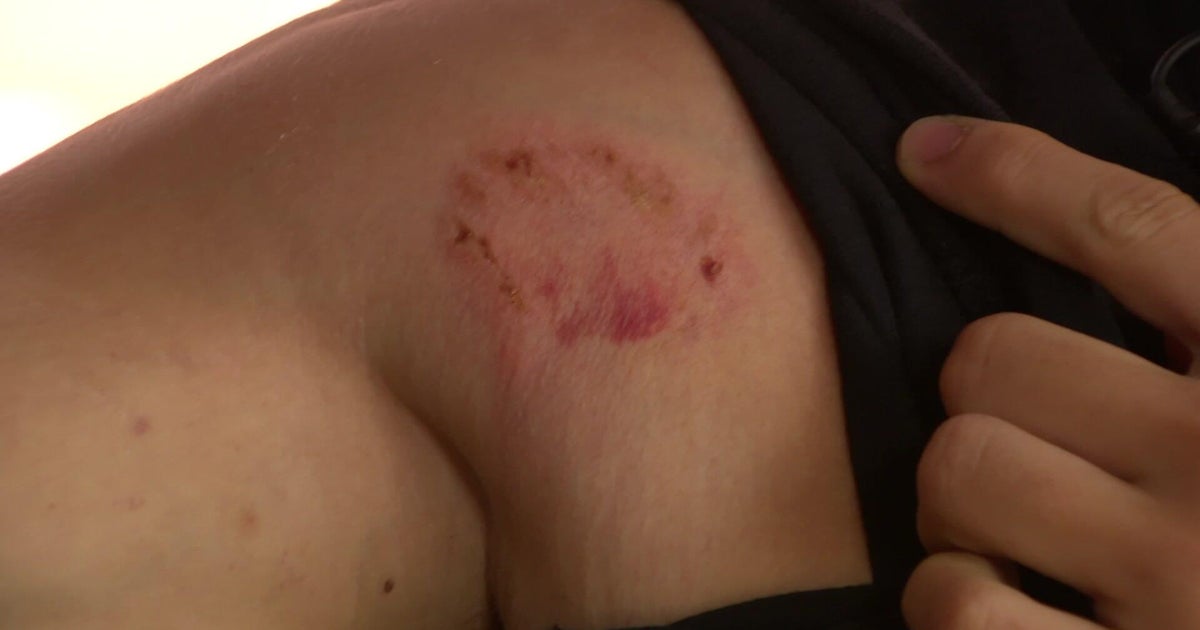 Lotus employee bit by attacker while taking out garbage 