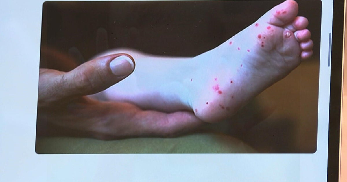 Cases of hand, foot and mouth disease are growing throughout the Philadelphia region 