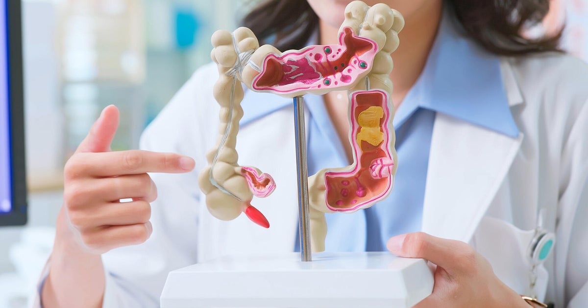 What’s fueling the rise of colon cancer in young people?