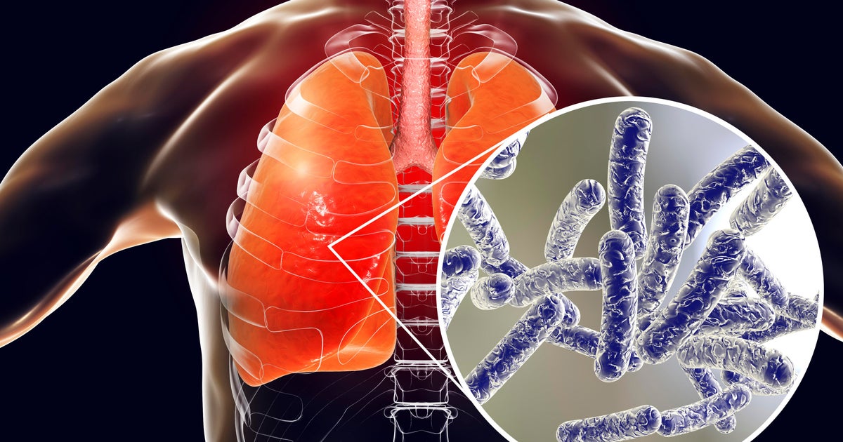 NYC officials give update on Legionnaires' disease outbreak in Harlem 
