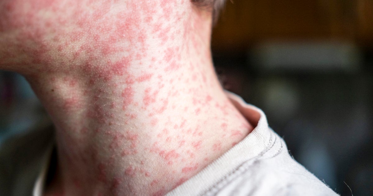 Possible measles exposure reported at Newark Liberty International Airport 