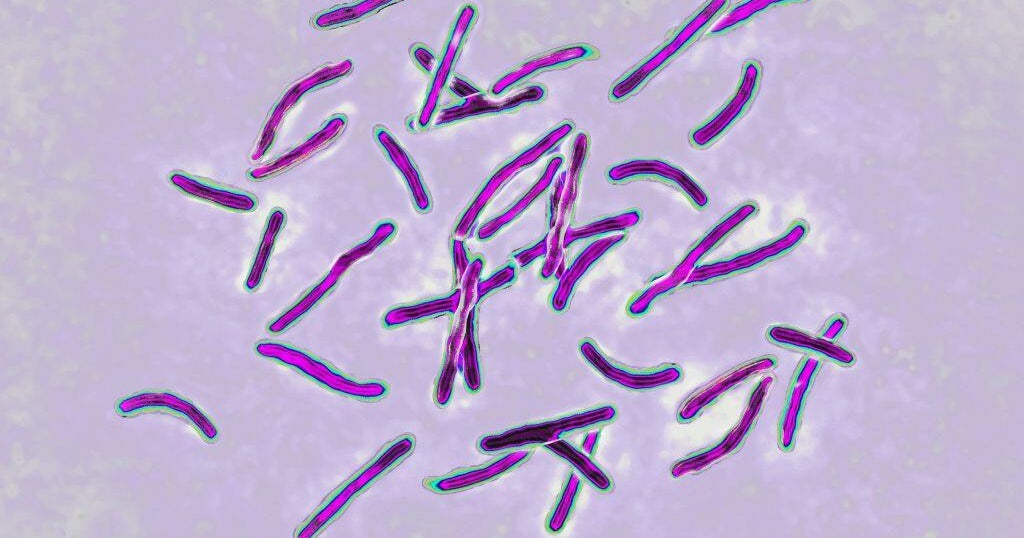 Tuberculosis case reported at Ventura County elementary school, health officials testing students 