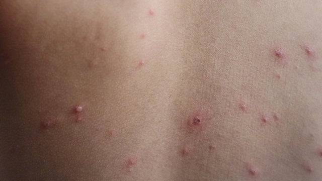 Measles 