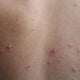 Second case of measles for 2025 confirmed in suburban Cook County 