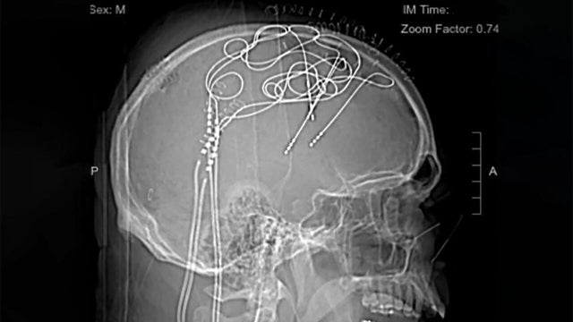 ed-mowery-brain-implants-ucsf.jpg 