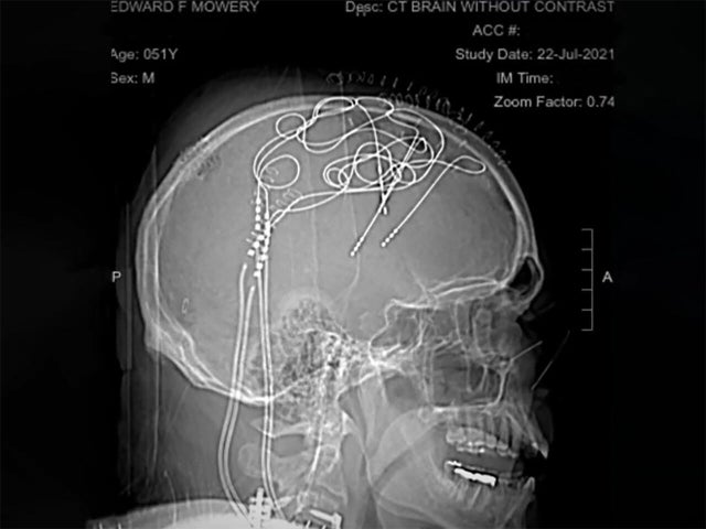 Brain/Update 田仲真治 治療DVD USED Brain/Update 田仲真治 治療DVD USED DVD/ブルーレイ