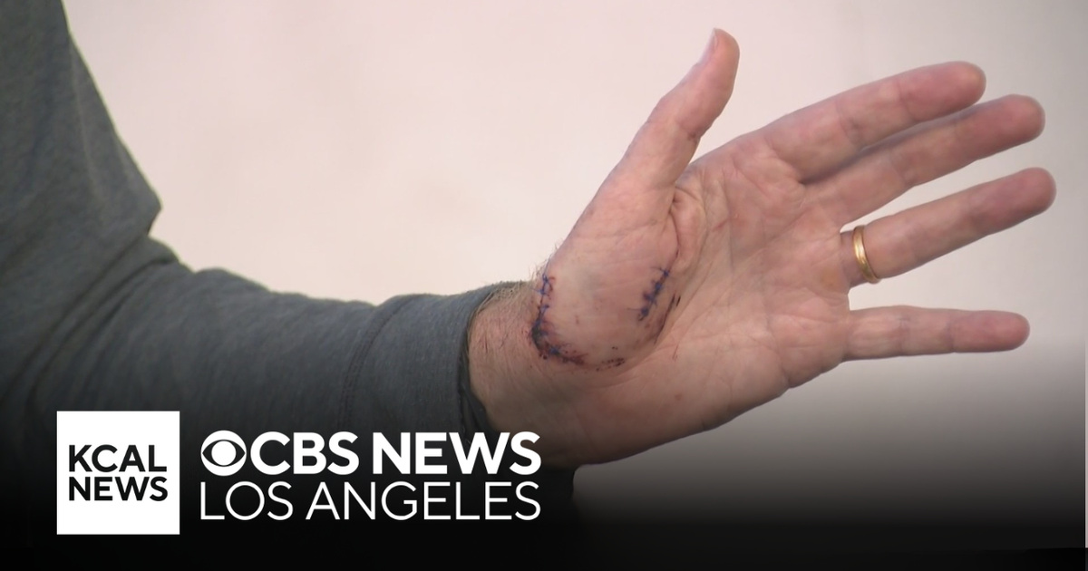 Swimmer talks about shark attack off Catalina Island coast - CBS Los ...