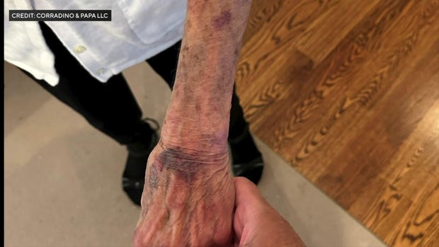 Bruises on 85-year-old woman's wrist 