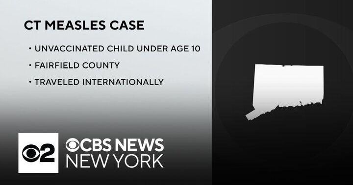 Connecticut has first measles case in 4 years